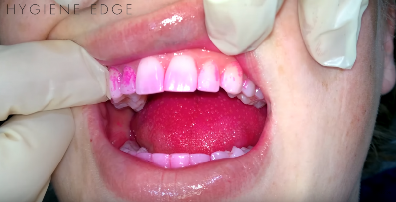 Dental CE course dental hygiene disclosing solution