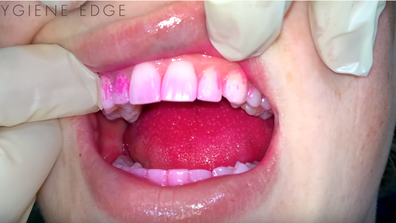 Dental CE course dental hygiene disclosing solution