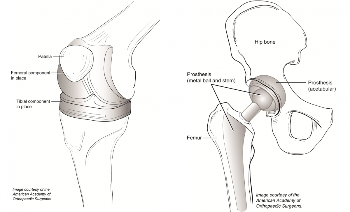 Newest antibiotic prophylaxis guidelines joints, heart, etc. Dental